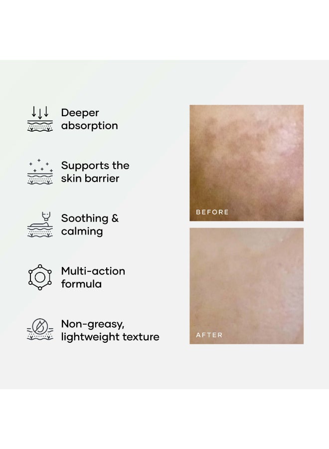 Cureskin Azelaic Clear Cream | Advanced Acne & Dark Spot Treatment - Image 3